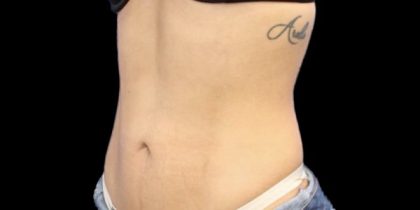 Liposuction/Liposculpture Before & After Patient #602