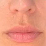 Dermal Fillers Before & After Patient #956