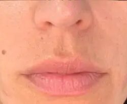 Dermal Fillers Before & After Patient #956