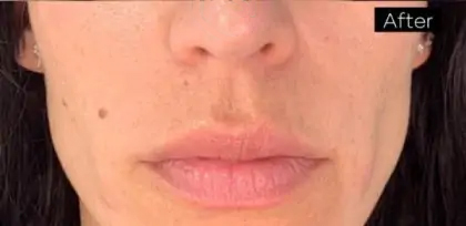 Dermal Fillers Before & After Patient #956