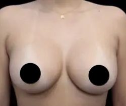 Breast Augmentation Before & After Patient #426