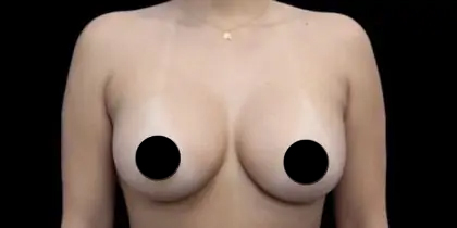 Breast Augmentation Before & After Patient #426