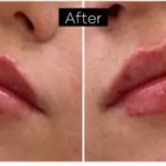 Dermal Fillers Before & After Patient #957