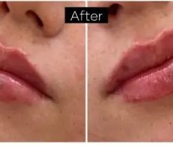Dermal Fillers Before & After Patient #957