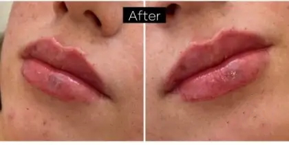 Dermal Fillers Before & After Patient #957