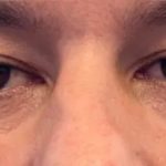 Morpheus8 Before & After Patient #958