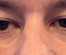 Morpheus8 Before & After Patient #958