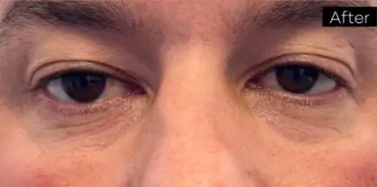Morpheus8 Before & After Patient #958