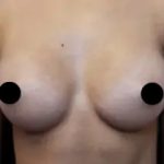 Breast Augmentation Before & After Patient #490