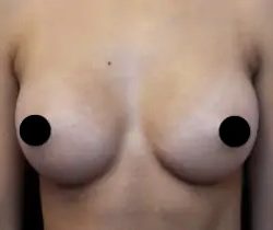 Breast Augmentation Before & After Patient #490
