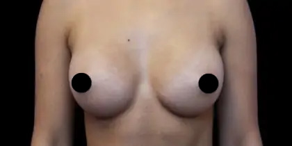 Breast Augmentation Before & After Patient #490