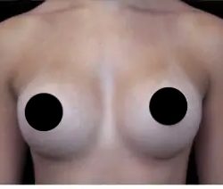 Breast Augmentation Before & After Patient #491