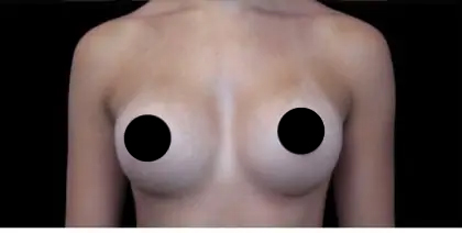 Breast Augmentation Before & After Patient #491