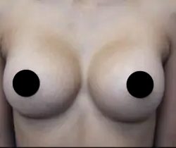 Breast Augmentation Before & After Patient #423