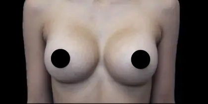 Breast Augmentation Before & After Patient #423