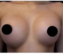 Breast Augmentation Before & After Patient #492