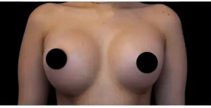Breast Augmentation Before & After Patient #492