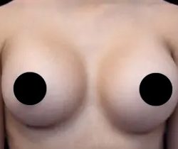 Breast Augmentation Before & After Patient #493