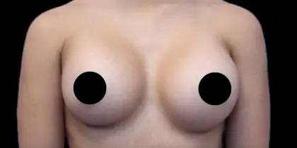 Breast Augmentation Before & After Patient #493