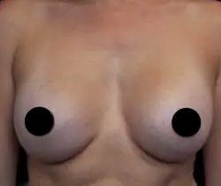 Breast Augmentation Before & After Patient #496