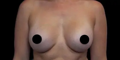 Breast Augmentation Before & After Patient #496