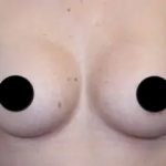 Breast Augmentation Before & After Patient #497