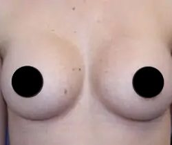 Breast Augmentation Before & After Patient #497