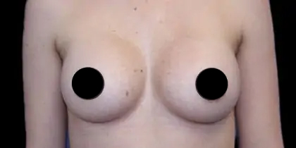 Breast Augmentation Before & After Patient #497