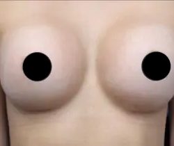 Breast Augmentation Before & After Patient #499
