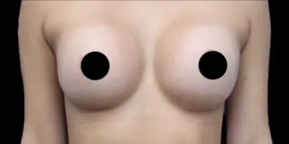 Breast Augmentation Before & After Patient #499