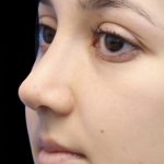 Primary Rhinoplasty Before & After Patient #809