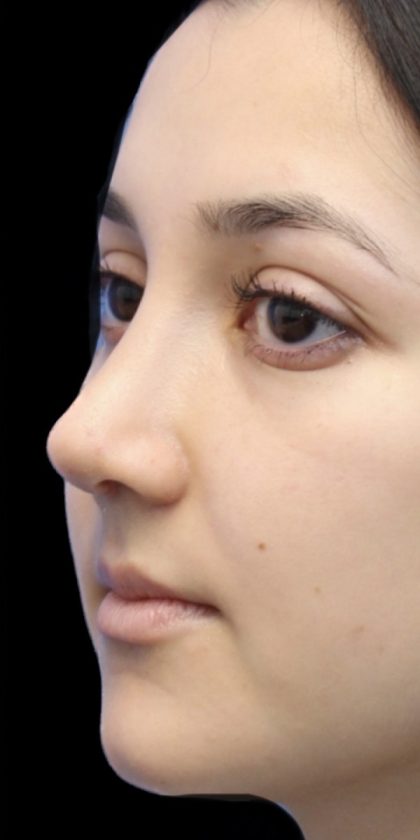 Primary Rhinoplasty Before & After Patient #809