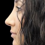 Primary Rhinoplasty Before & After Patient #822