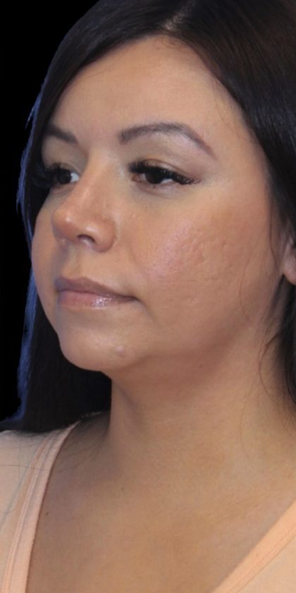 Primary Rhinoplasty Before & After Patient #826