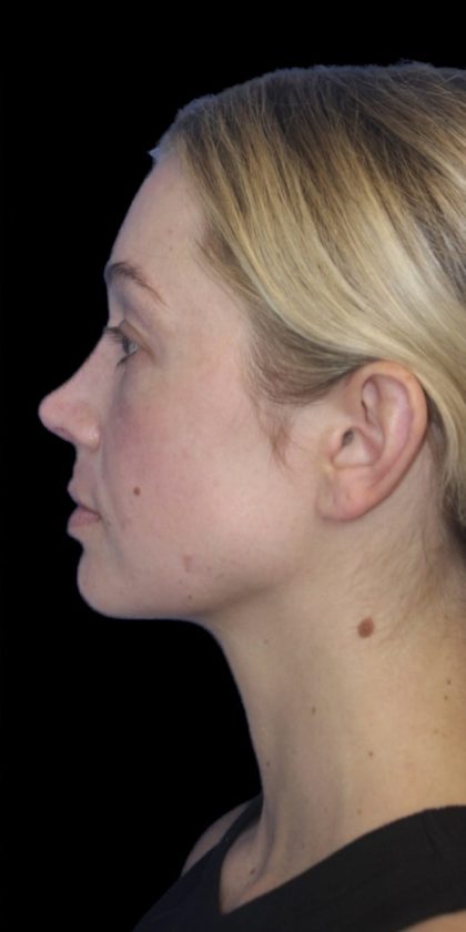 Primary Rhinoplasty Before & After Patient #839