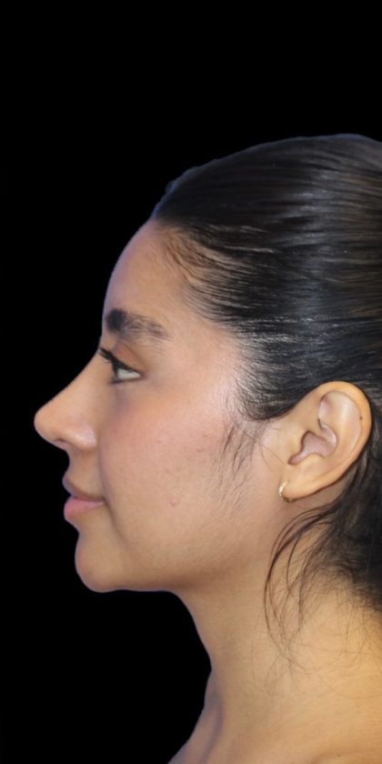 Primary Rhinoplasty Before & After Patient #840