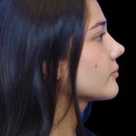 Primary Rhinoplasty Before & After Patient #841