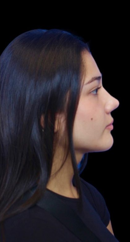 Primary Rhinoplasty Before & After Patient #841