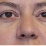 Blepharoplasty Before & After Patient #387