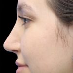 Primary Rhinoplasty Before & After Patient #842