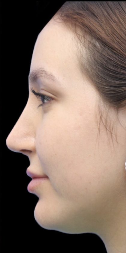 Primary Rhinoplasty Before & After Patient #842