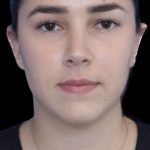 Primary Rhinoplasty Before & After Patient #843