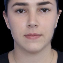 Primary Rhinoplasty Before & After Patient #843