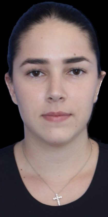 Primary Rhinoplasty Before & After Patient #843
