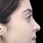 Primary Rhinoplasty Before & After Patient #854
