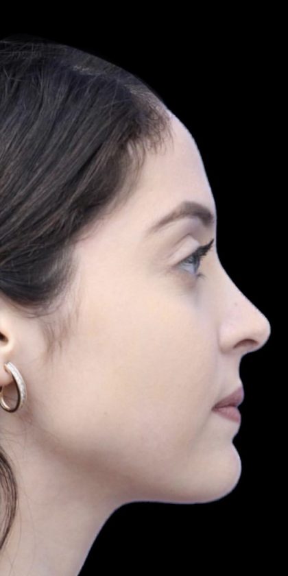Primary Rhinoplasty Before & After Patient #854