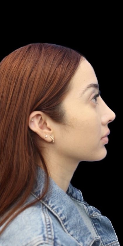 Primary Rhinoplasty Before & After Patient #858