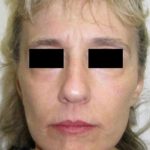 Facelift Before & After Patient #573