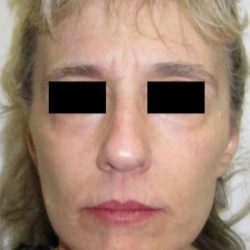 Facelift Before & After Patient #573