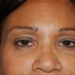 Blepharoplasty Before & After Patient #389